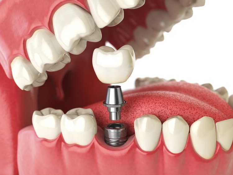 dental implant components