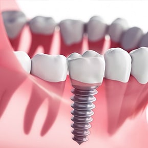 dental implant illlustration
