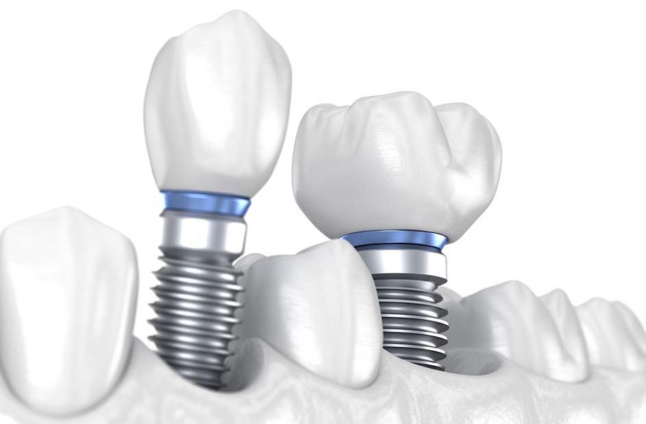 closup view double dental implant illustration