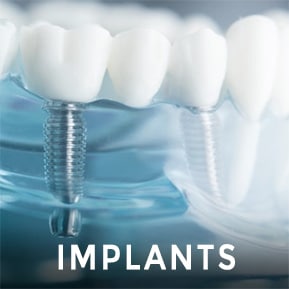 model of dental implant bridge