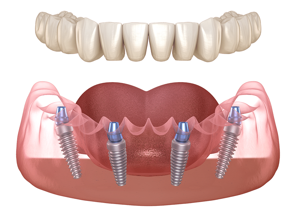illustration of all on 4 dental implants