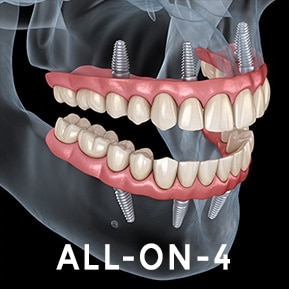 model of all on 4 dental implants