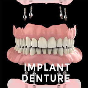 implant supported denture